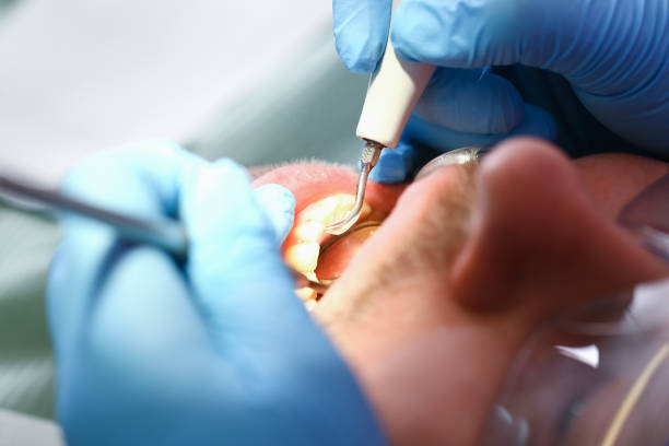 Best Emergency Tooth Extraction in Maplewood, MN